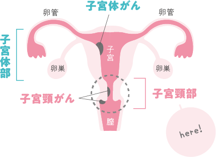 「子宮頸がん」ってどこのがん？